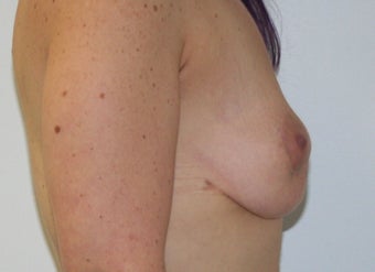 25-34 year old woman treated with Fat Transfer 1676917
