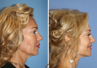 Lower FaceLift & Neck Lift Under Local Anesthesia (No General Anesthesia Needed) 251836