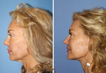 Lower FaceLift & Neck Lift Under Local Anesthesia (No General Anesthesia Needed) after 251836