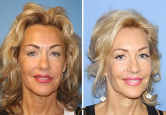 Lower FaceLift & Neck Lift Under Local Anesthesia (No General Anesthesia Needed) before 251836