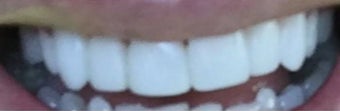 25-34 year old woman treated with Dental Bonding after 3035703