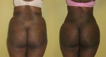 Brazilian Butt Lift in An African American Patient With a Square Buttock Deformity before 1247542