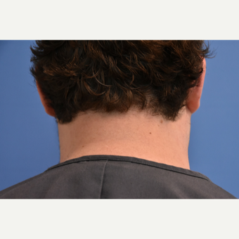 18-24 year old man treated with IPL Hair Reduction after 3211549