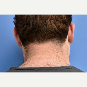18-24 year old man treated with IPL Hair Reduction before 3211549
