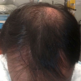 Man treated with NeoGraft before 3124218