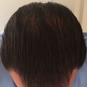 Man treated with NeoGraft after 3124218