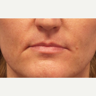 35-44 year old woman treated with Lip Augmentation before 3675188
