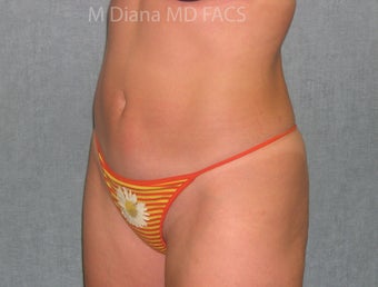 SmartLipo 607526