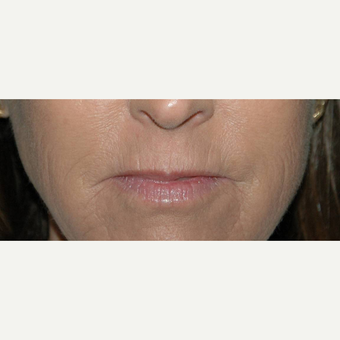 62 year old woman treated with Lip Augmentation before 3710949