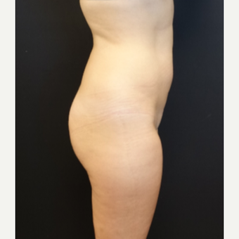 25-34 year old woman treated with Butt Implants before 3629829