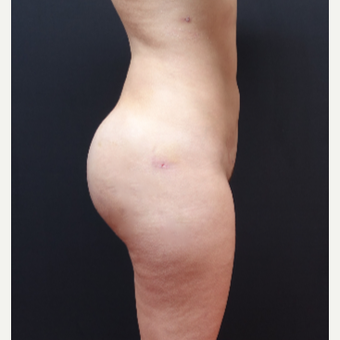 25-34 year old woman treated with Butt Implants after 3629829