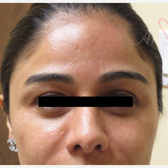 25-34 year old woman treated with Acne Scars Treatment before 3375029