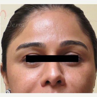 25-34 year old woman treated with Acne Scars Treatment after 3375029