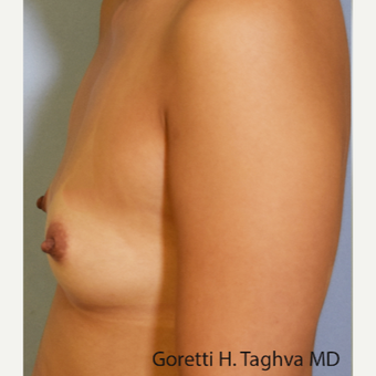 35-44 year old woman treated with Breast Fat Transfer before 3726939