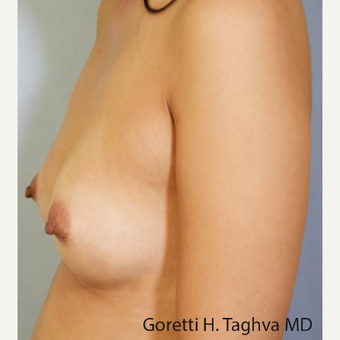 35-44 year old woman treated with Breast Fat Transfer after 3726939