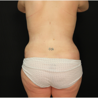 34 year old female with abdominoplasty (tummy tuck) and liposuction of hips after 3576194