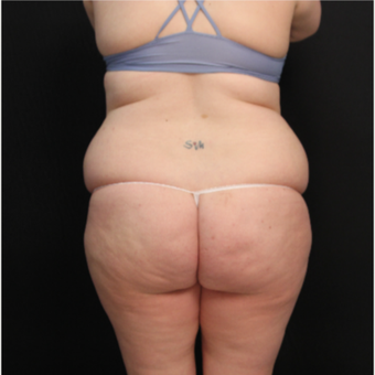 34 year old female with abdominoplasty (tummy tuck) and liposuction of hips before 3576194