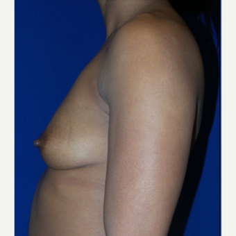 37 year old mother of three treated with Breast Augmentation before 3320058