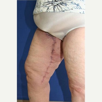 55-64 year old woman treated with Thigh Lift after Weight Loss 1949995