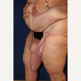 55-64 year old woman treated with Thigh Lift after Weight Loss 1949995