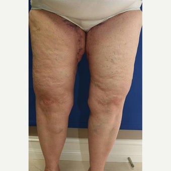 55-64 year old woman treated with Thigh Lift after Weight Loss after 1949995
