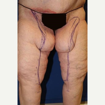 55-64 year old woman treated with Thigh Lift after Weight Loss before 1949995
