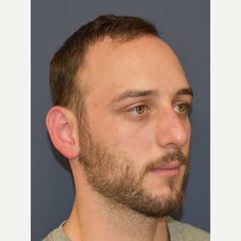 18-24 year old man treated with Nose Surgery after 3067122
