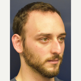 18-24 year old man treated with Nose Surgery before 3067122