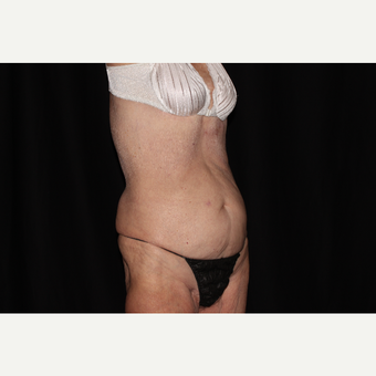 75 and up year old woman treated with SculpSure after 3748731