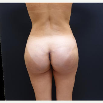 35-44 year old woman treated with 548cc Butt Implants for her Butt Lift after 3235663
