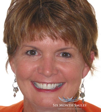 Six Month Smile/ Short term orthodontics after 490336