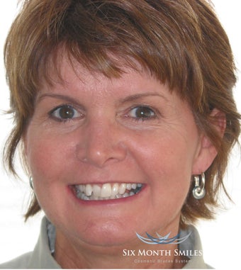 Six Month Smile/ Short term orthodontics before 490336