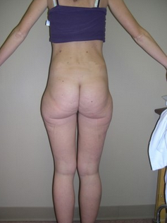 Liposuction before 1191079