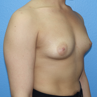 25-34 year old woman treated with Breast Augmentation before 3254653