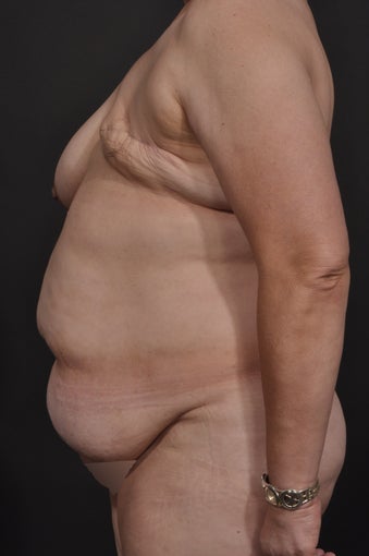 Breast Reconstruction before 927735