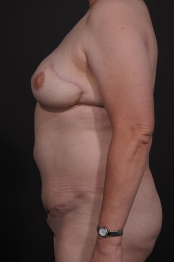 Breast Reconstruction after 927735