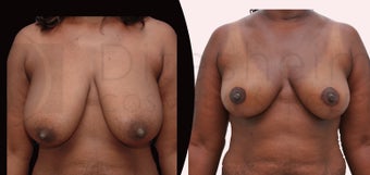 Breast reduction african american female before 1113785