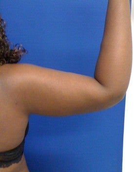 Laser Liposuction 561207