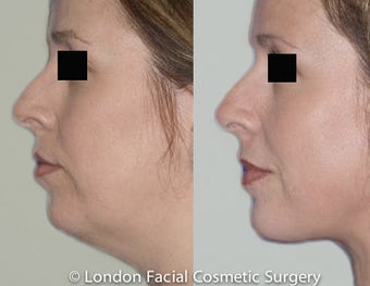 Neck lifting Case: Review Before & After Photograph before 997650