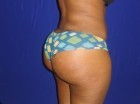 21 Year Young Patient, had Butt Augmentation with Fat Grafting 4 years ago after 1118280