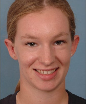 Otoplasty after 1268328