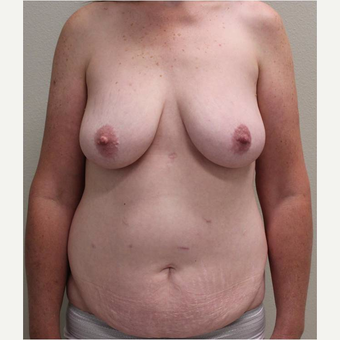 45-54 year old woman treated with Mommy Makeover before 3445809