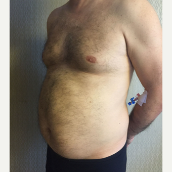 35-44 year old man treated with Liposuction on Chest and Abdomen area before 3569030