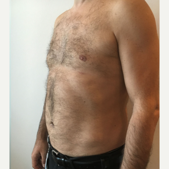 35-44 year old man treated with Liposuction on Chest and Abdomen area after 3569030