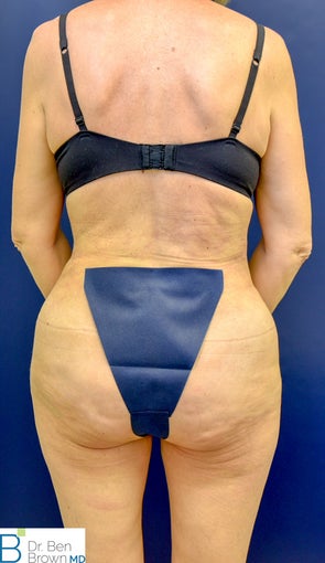 45-54 year old woman treated with Liposuction, Abdominopalsty and Fat Grafting to lateral butt 2872908