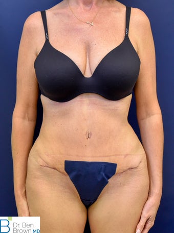 45-54 year old woman treated with Liposuction, Abdominopalsty and Fat Grafting to lateral butt after 2872908