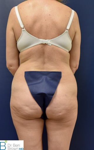 45-54 year old woman treated with Liposuction, Abdominopalsty and Fat Grafting to lateral butt 2872908