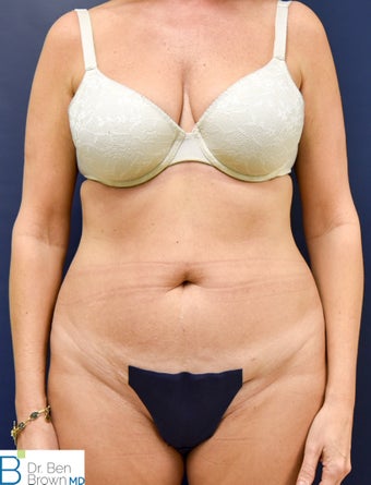 45-54 year old woman treated with Liposuction, Abdominopalsty and Fat Grafting to lateral butt before 2872908