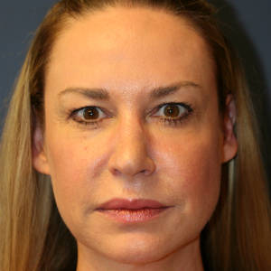 45-54 year old woman treated with Eyelid Surgery before 3555469