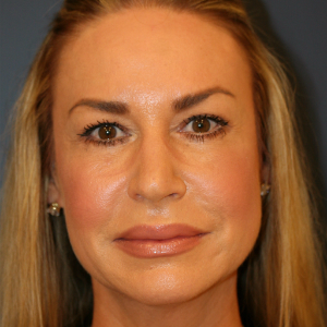 45-54 year old woman treated with Eyelid Surgery after 3555469